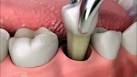 Удаление зуба в Самаре